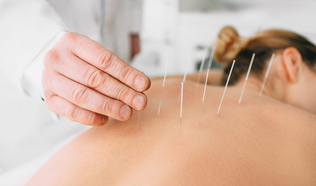 What is Chinese Acupuncture 